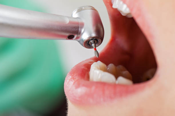 Best Emergency Dental Care for Abscessed Tooth in South Rosemary, NC